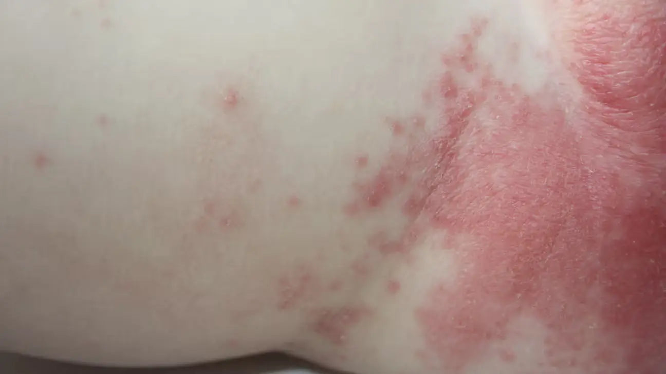 Best Diapers for Sensitive Skin and Rash-Prone Babies